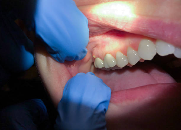 Best Emergency Root Canal Therapy in Lincoln, MO